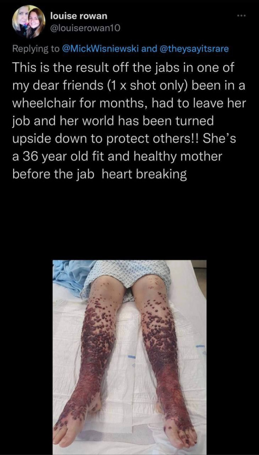 Click image for larger version

Name:	1 jab only.jpg
Views:	41
Size:	131.8 KB
ID:	1010